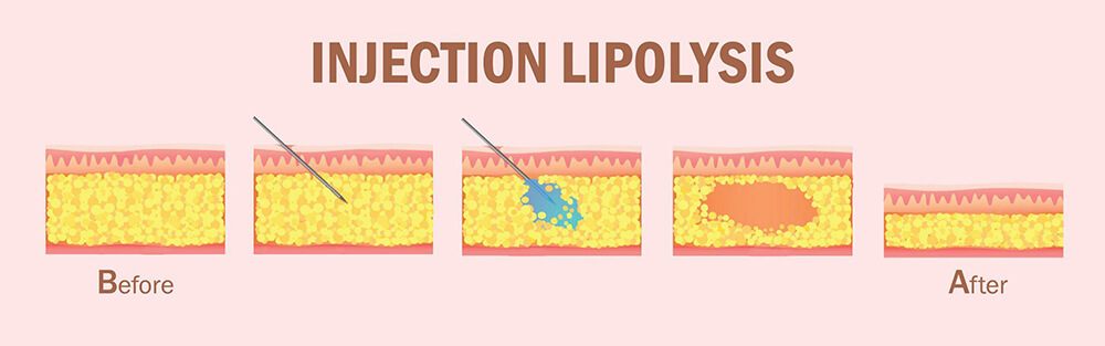 Injection Lipolysis Process