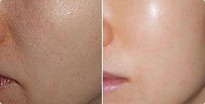 Baby Skin PDRN Before and After