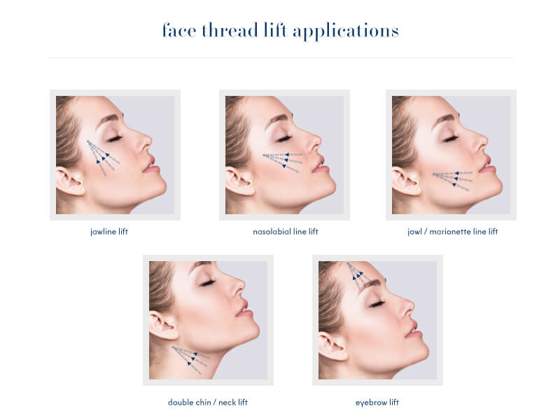Face Thread Lift Applications
