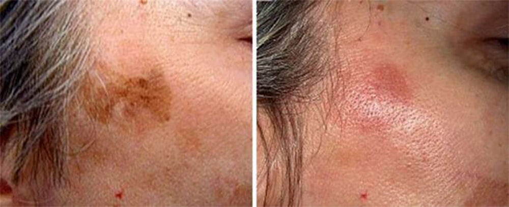 Q Switch Laser Treatment Before and After