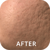 After Improved Skin Texture