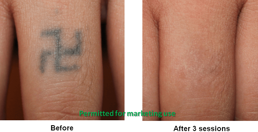 Picoplus Laser Clinic Mf