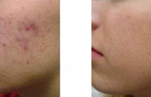 Before/After PRP 2