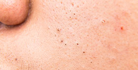 Lumps and bumps treatment