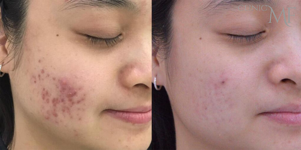 Before and after Luxe Peel