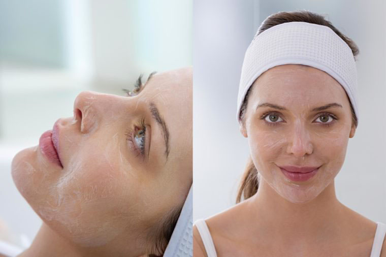 Chemical Peel Treatment