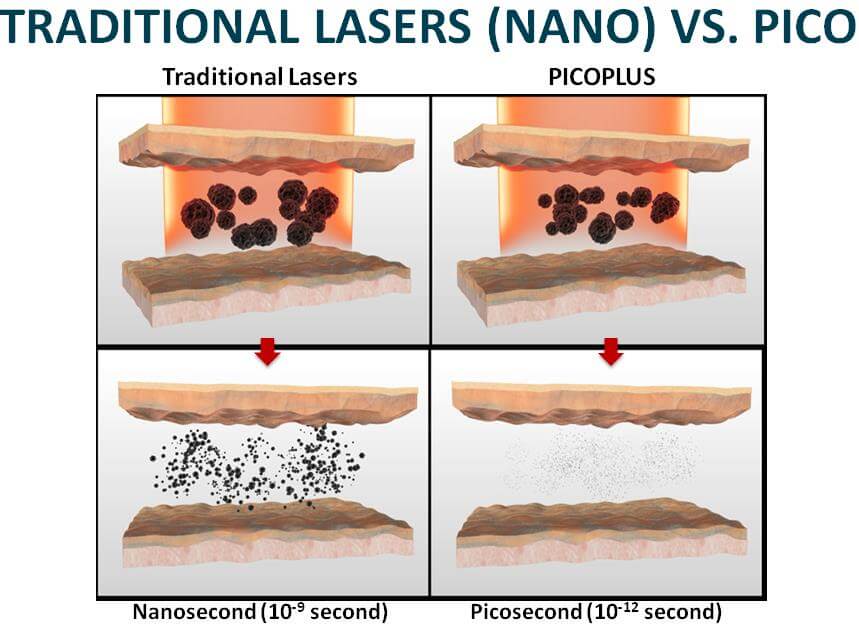 Traditional Laser Nano vs Pico