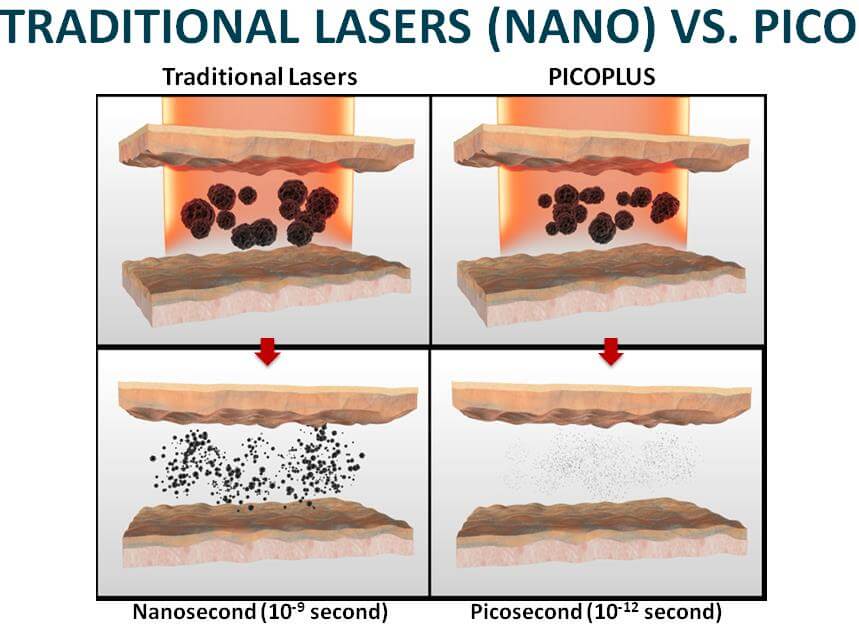 photograv vs photo laser plus photograv vs photo laser plus