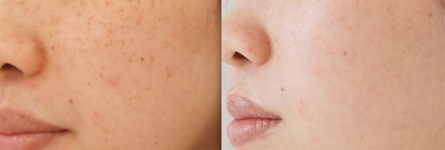 Before and After Laser Pigment Removal Asian Skin