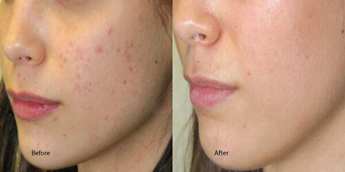 Before and After Chemical Peel Acne Redondo Beach