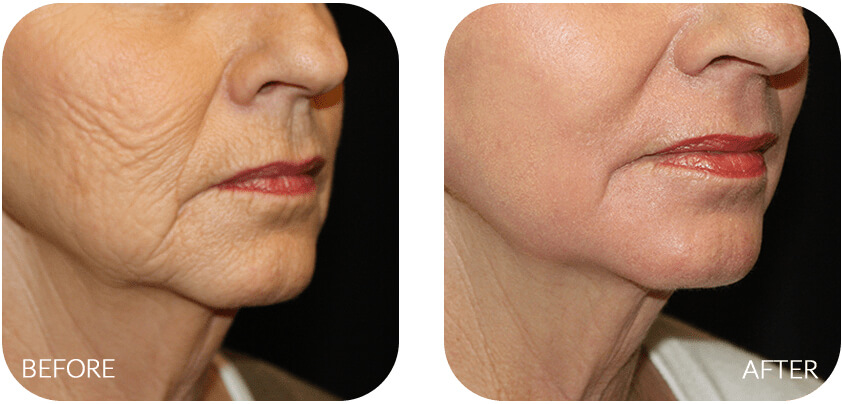 Chemical Peels Before and After
